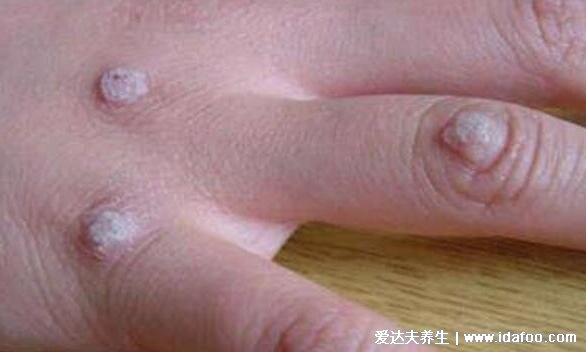 100种皮肤病对照表图片大全,方便大家查看自我症状(胆小慎入)