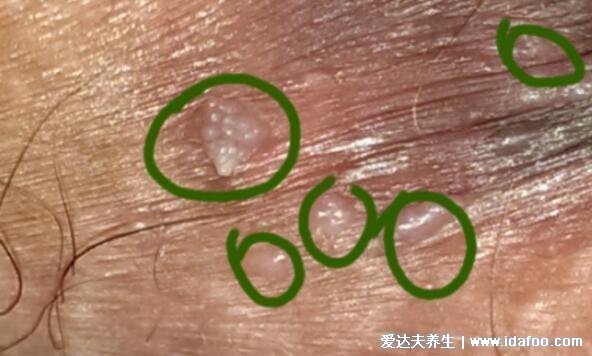 100种皮肤病对照表图片大全,方便大家查看自我症状(胆小慎入)