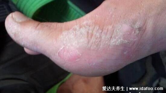 100种皮肤病对照表图片大全,方便大家查看自我症状(胆小慎入)