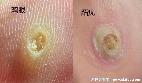 100种皮肤病对照表图片大全,方便大家查看自我症状(胆小慎入)