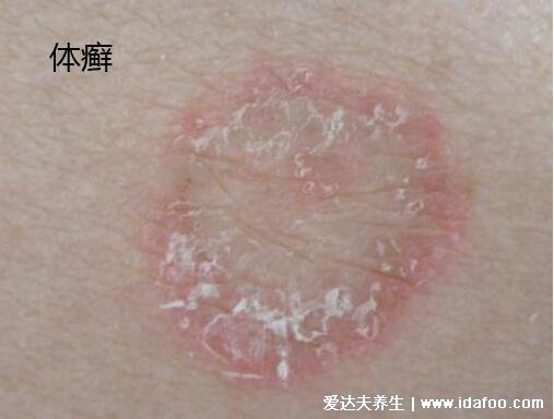 100种皮肤病对照表图片大全,方便大家查看自我症状(胆小慎入)