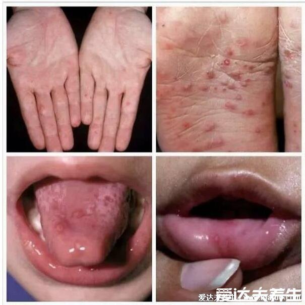 100种皮肤病对照表图片大全,方便大家查看自我症状(胆小慎入)