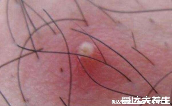 100种皮肤病对照表图片大全,方便大家查看自我症状(胆小慎入)