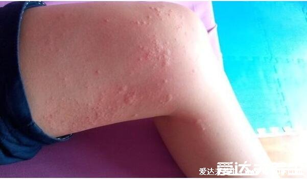 100种皮肤病对照表图片大全,方便大家查看自我症状(胆小慎入)