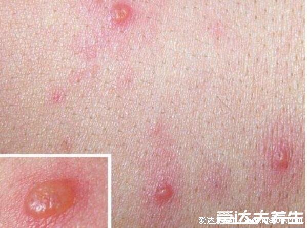 100种皮肤病对照表图片大全,方便大家查看自我症状(胆小慎入)