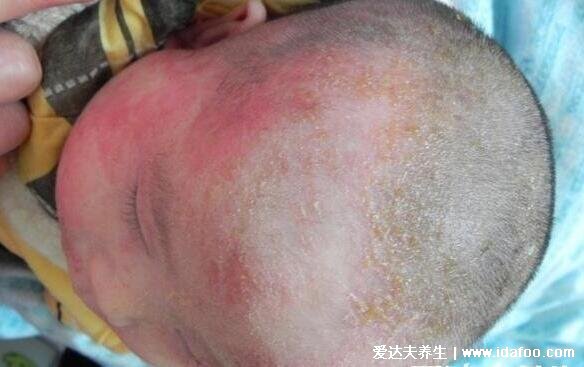 100种皮肤病对照表图片大全,方便大家查看自我症状(胆小慎入)