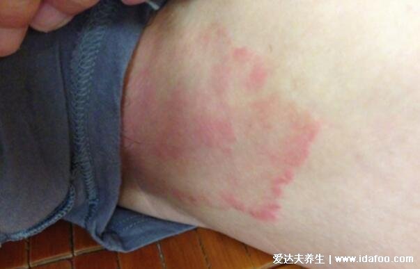 100种皮肤病对照表图片大全,方便大家查看自我症状(胆小慎入)