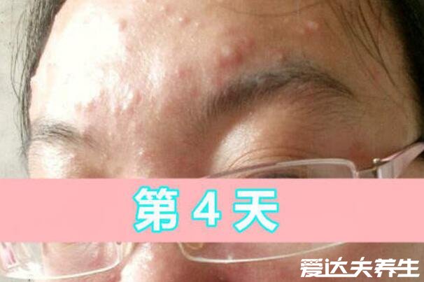 水痘的7天演变过程图片，从红色皮疹到水泡到结痂脱落痊愈